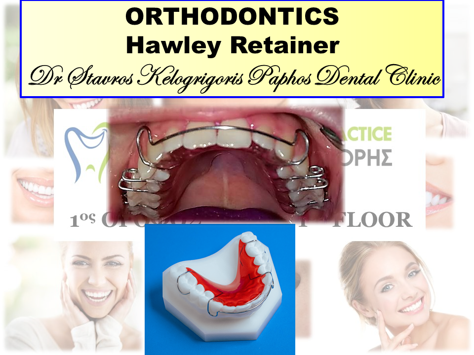 clear aligner